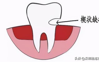牙齿断了怎么办最简单方法（牙齿缺损，牙齿断裂应该怎么办？这些修复方法你知道吗？）