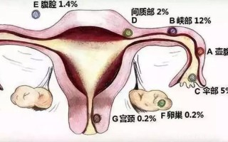 8个征兆说明你宫外孕了，异常阴道出血只是其一